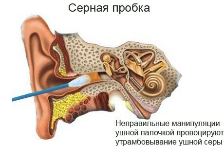 серная пробка